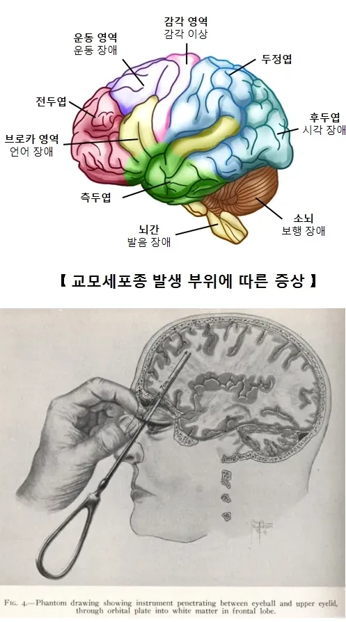 인류가 알고 있는 유일한 조현병 완치법 (2/2)
