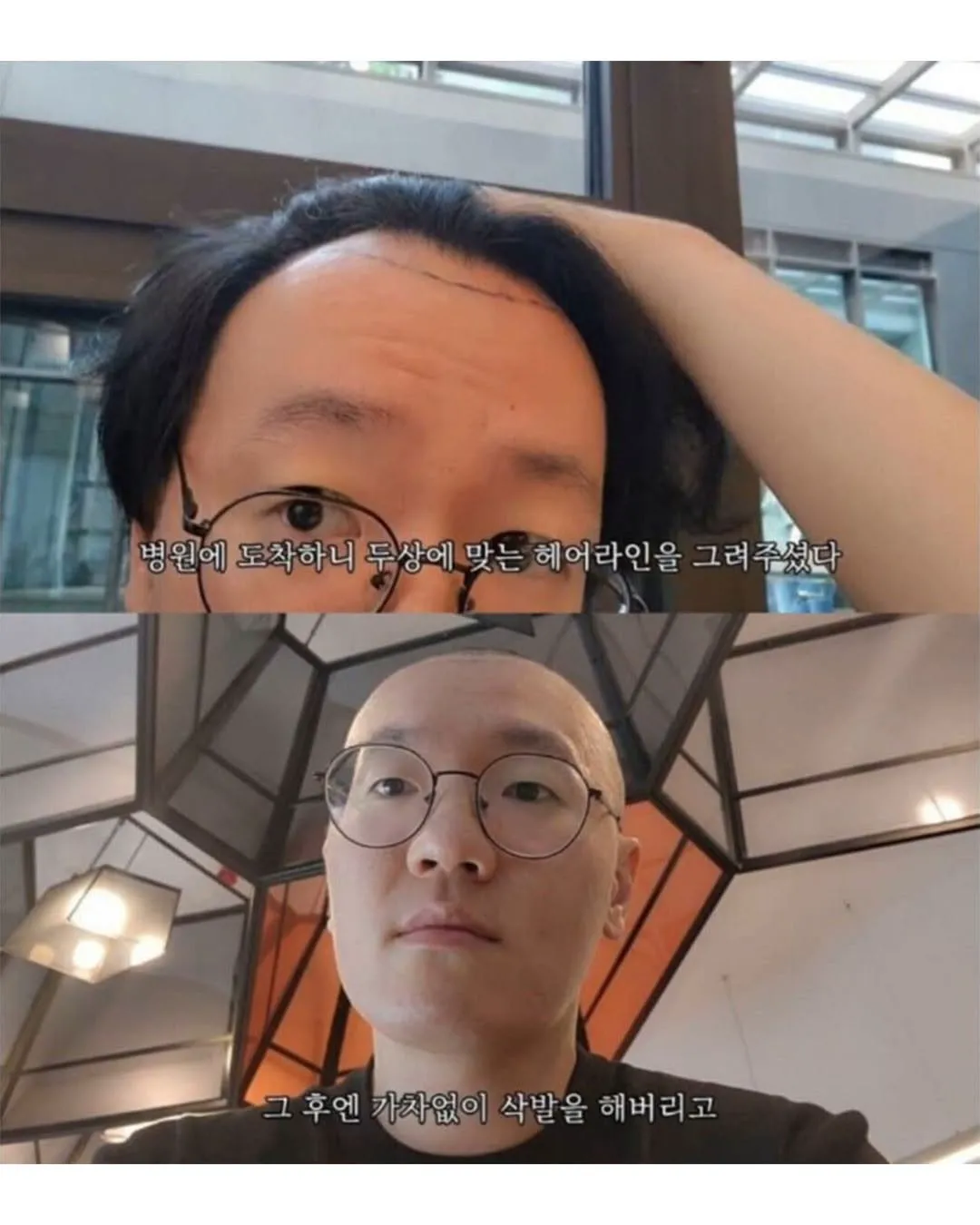 터키로 모발이식 받으러간 남자의 최후.jpg (2/6)