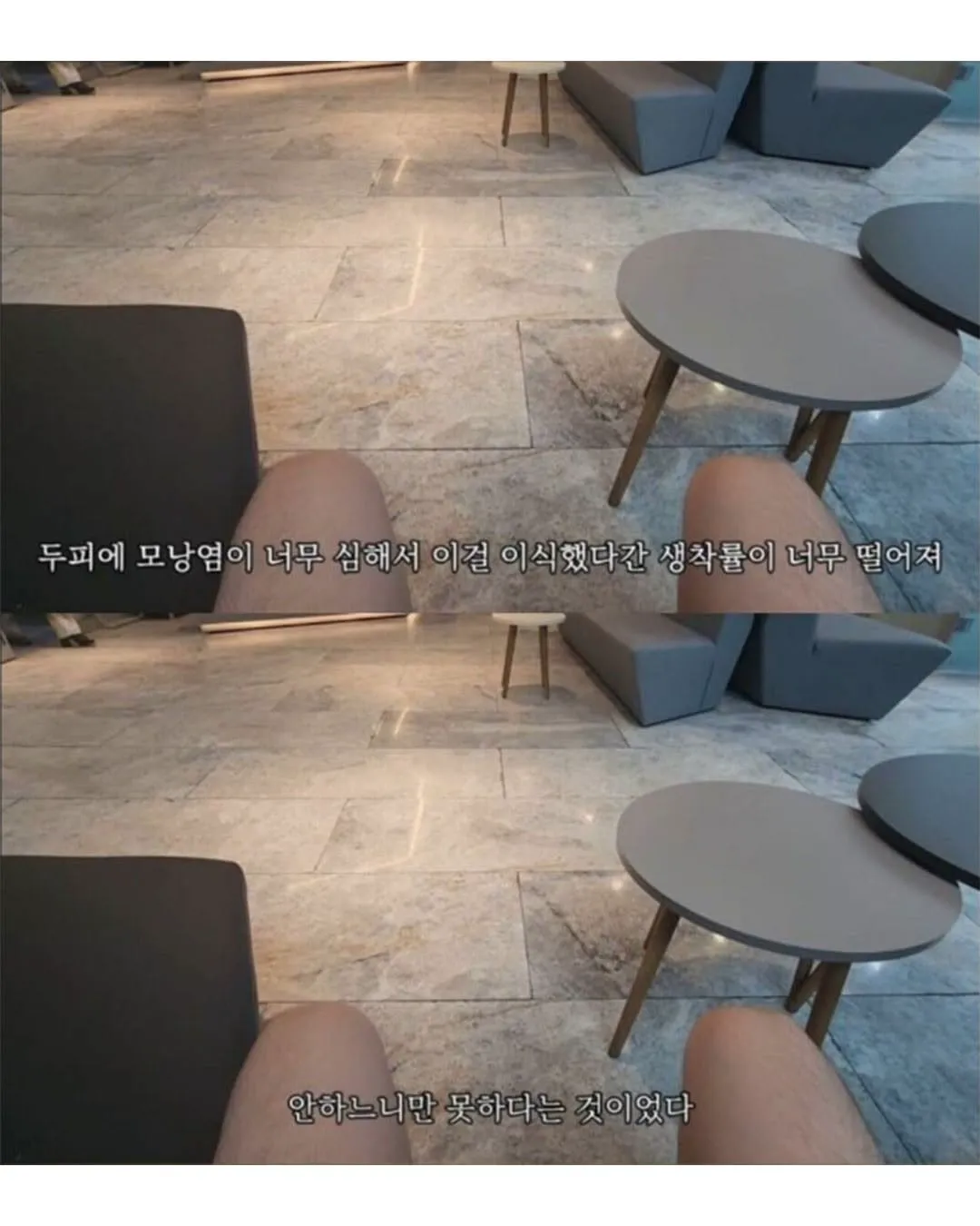 터키로 모발이식 받으러간 남자의 최후.jpg (4/6)